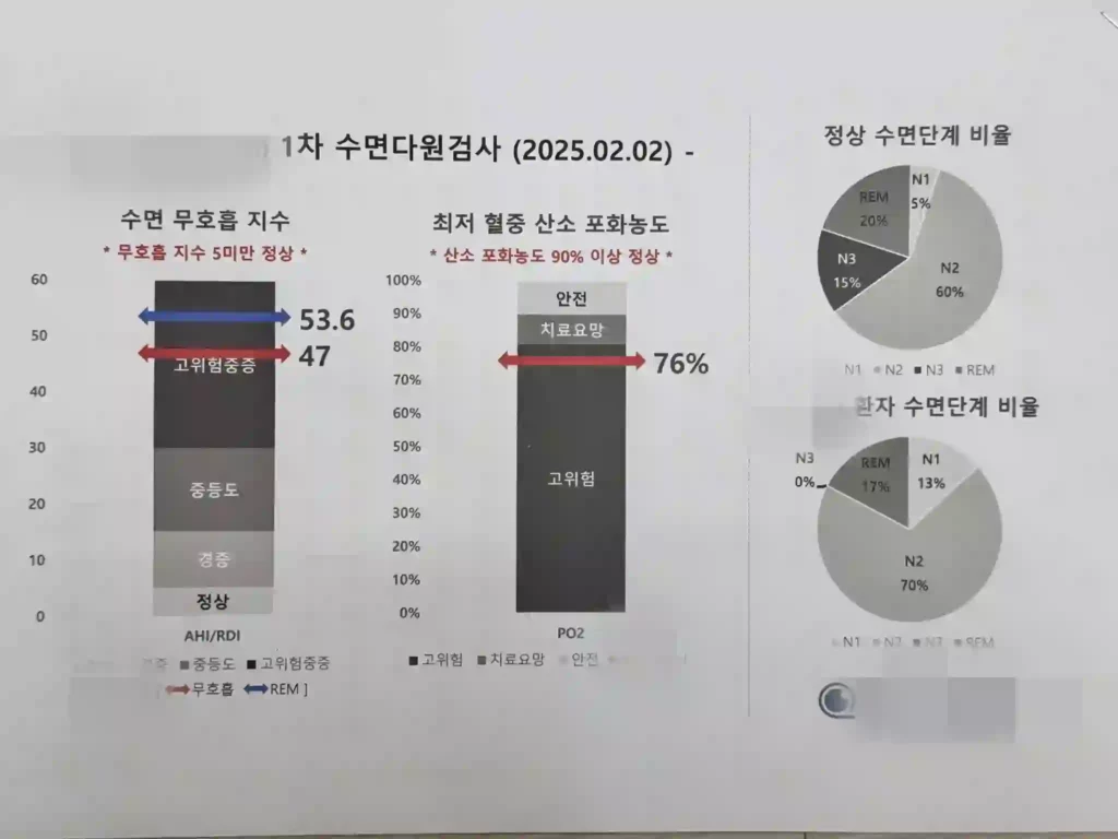 수면다원검사 결과